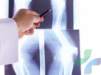 osteoporose ortopedista brasilia